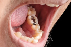 奥歯の銀歯詰め物