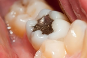 奥歯の銀歯が目立つ
